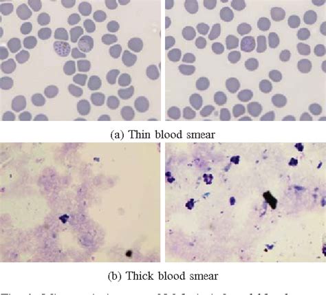 thick vs thin smear malaria